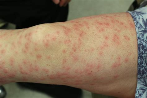 What Causes A Maculopapular Rash Health And Detox And Vitamins