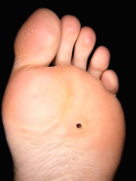 Hpv Warts On Bottom Of Feet Wart On Foot With Black Spots Wart On My