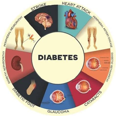 Diabetes Mellitus Type 2 Symptoms Complications And Treatment