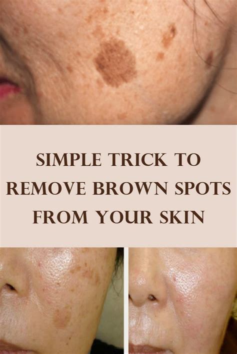 Simple Trick To Remove Brown Spots From Your Skin With Images Skin