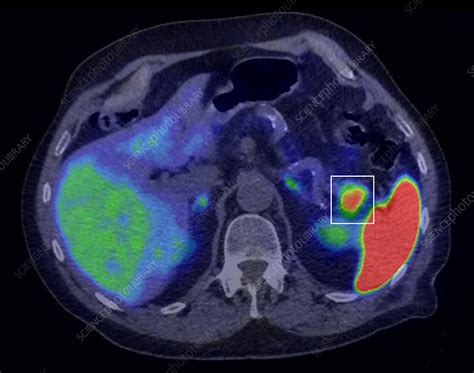 Pancreatic Cancer CT And PET Scans Stock Image C Science