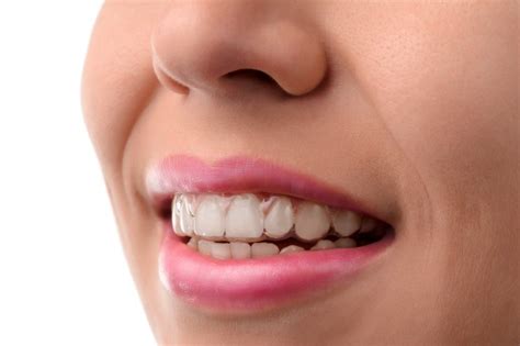 Dos And Donts Of Wearing Invisalign Braces Long Island Beautiful Smiles