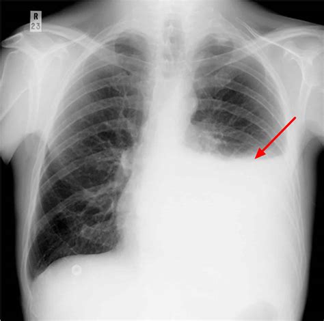 Posteroanterior Chest Radiograph Showing Right Pleural Effusion And A Sexiz Pix