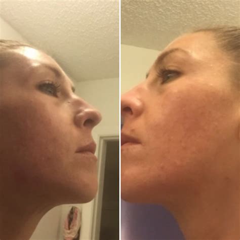 curology review for acne 5 week results