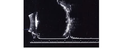 Ultrasound A Scan Showing A Single High Spike Around 5 Oclock