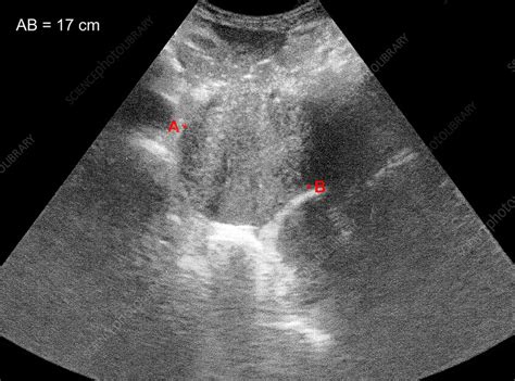 Pancreatic Adenocarcinoma Ultrasound