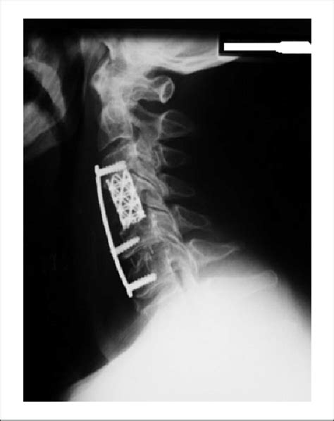 Lateral View Of Cervical Spine Showed C4 Corpectomy With Vertebral Body