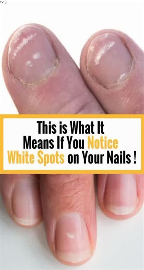 Awasome What Do White Lines Mean On Your Nails Ideas Fsabd42