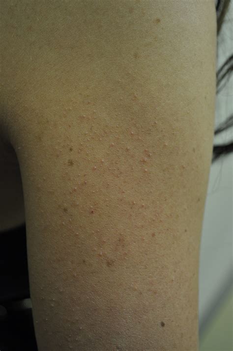 Goose Skin On Arms Dorothee Padraig South West Skin Health Care