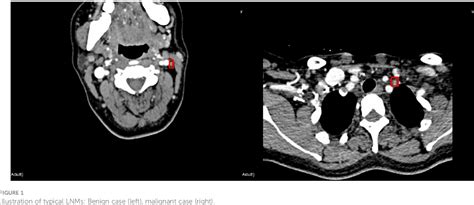 Figure 1 From Diagnosis Of Cervical Lymph Node Metastasis With Thyroid