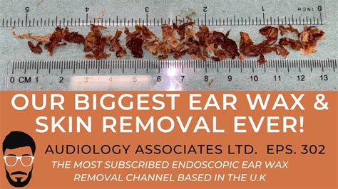 Our Biggest Ear Wax And Skin Removal Ever 2020 Ep 302 Youtube
