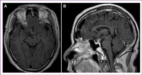 Postoperative T1 Weighted Postcontrast Mri In Axial A And Sagittal B