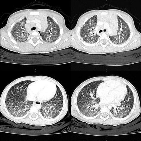 Chest Ct Scan Shows Diffuse Marked Thickening Of The Pulmonary