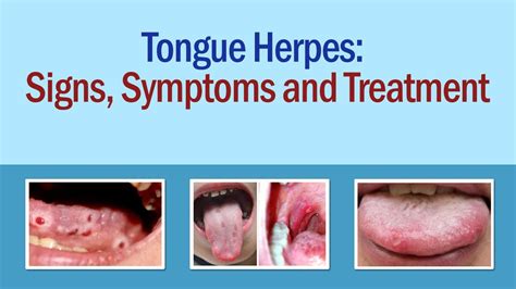 Tongue Herpes Signs And Symptoms Of Tongue Herpes How To Treat