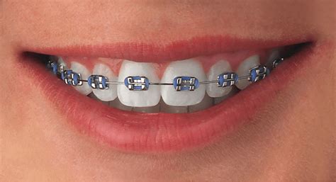 Conventional Braces Treatment Kl And Selangor Smile Beauty