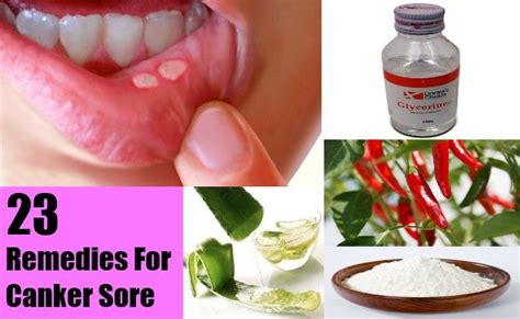 23 Home Remedies For Canker Sore Kruiden