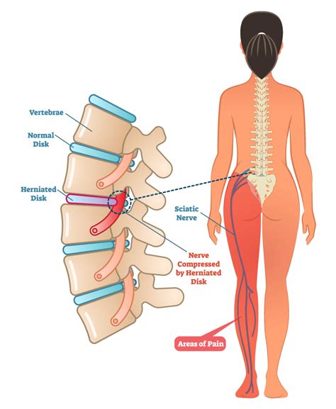 These movements only occur in several he is the anatomy lead for geeky medics. Sciatica | Altair Health
