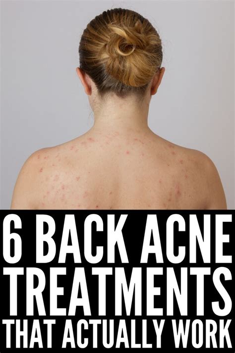 How To Get Rid Of Back Acne 11 Tips And Remedies That Work Cystic