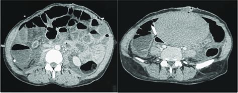 Ct Scan Of The Abdomen Showing Intraperitoneal Free Fluid With