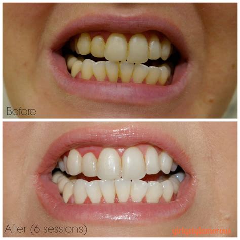 Review Of Smile Brilliant Custom Trays Teeth Whitening Before And After