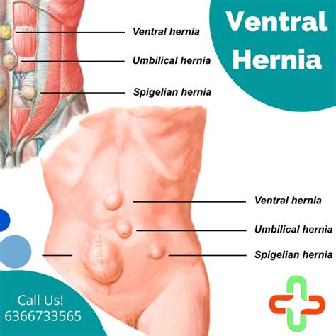 Ventral Hernia Types Of Muscles Rectus Muscle Epigastric Hernia