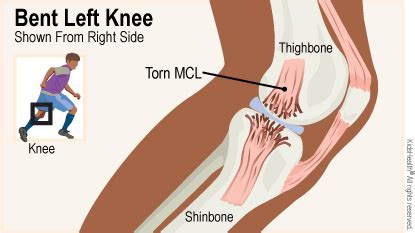 A ligament is the fibrous connective tissue that connects bones to other bones. Medial Collateral Ligament (MCL) Injuries (for Teens) - Nemours KidsHealth