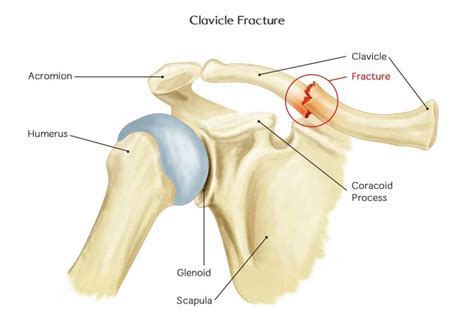 Clavicle Fracture Broken Collarbone Shoulder Doctor