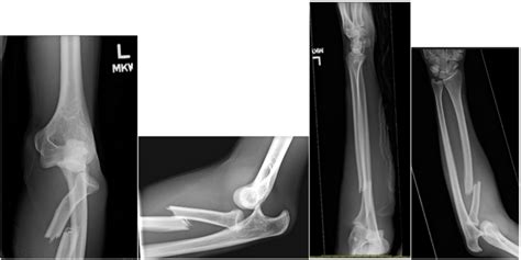 Four Orthogonal Radiographic Views Of The Elbow And Forearm
