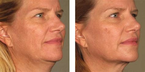 Ultherapy Nyc Non Surgical Facelift Manhattan Tribeca Medspa