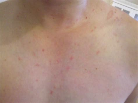 Itchy Rash On Neck And Chest Pictures Photos