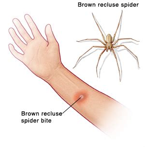 Brown Recluse Spider Bite
