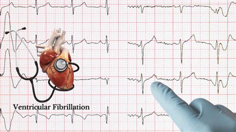 Ventricular Fibrillation Vfib Treatment Meaning Types Symptoms