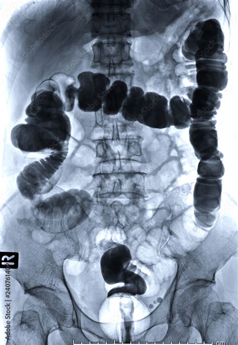 Barium Enema Image Front View Is A Rectal Injection Of Barium Contrast