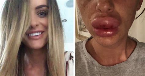 Along with rave reviews, botox before and after pics provide a great resource for men and women who wonder if botox may be an effective solution for helping them look younger and more energized. Woman issues shocking pictures to warn others after Botox ...