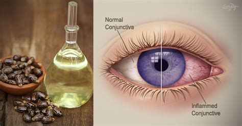 3 Wonderful Benefits Of Castor Oil For Your Eyes