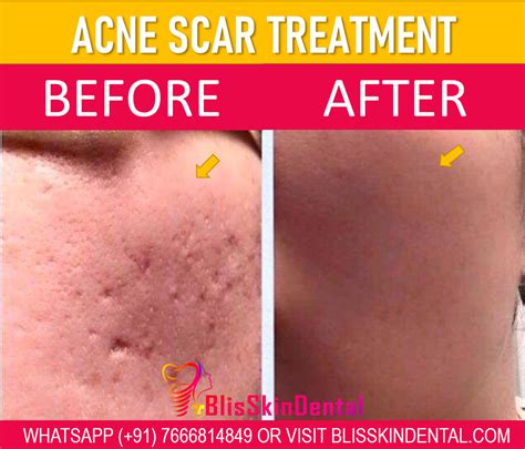Acne Scar Treatment In Bandra Mumbai At Bliss Skin Clinic