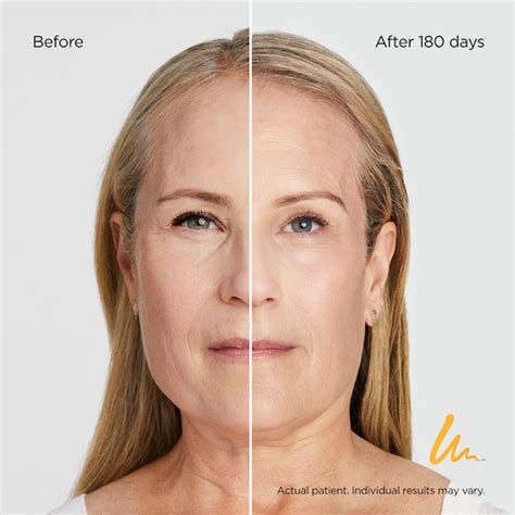 Ultherapy Nyc Non Surgical Lift And Skin Tightening