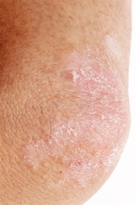 Psoriasis Skin Lesions