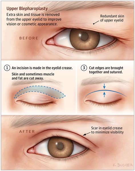 Upper Blepharoplasty Пластическая хирургия Лицо Глаза