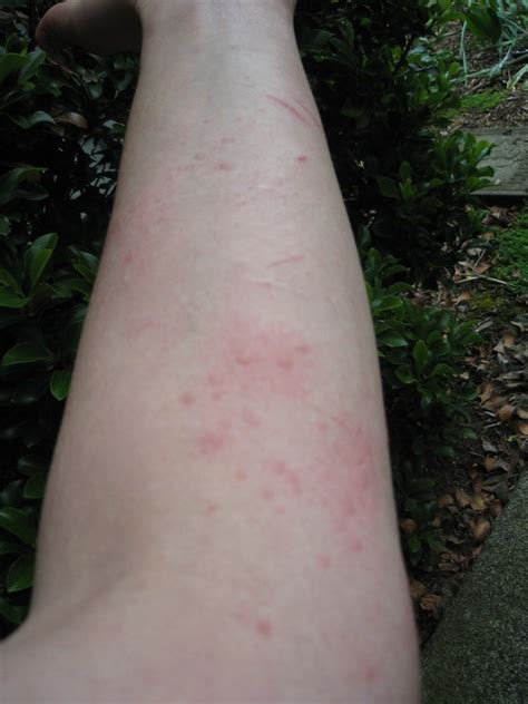 Woke Up This Morning With A Rash On My Forearm Flickr Photo Sharing