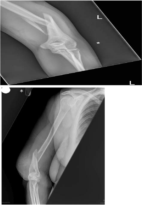 Figure From Distal Third Humeri Fractures Treated Using The Synthes Mm Extra Articular