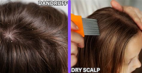 Dandruff Vs Dry Scalp Understanding The Difference