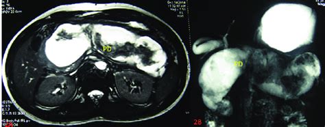 Mri Of Abdomen 2a Mri With T2 Sequences 2b Mrcp Showing Dilated