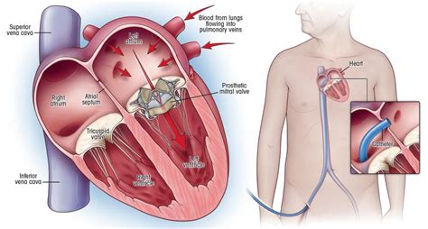 An Overview About Mitral Valve Surgery Ehealth Quotes