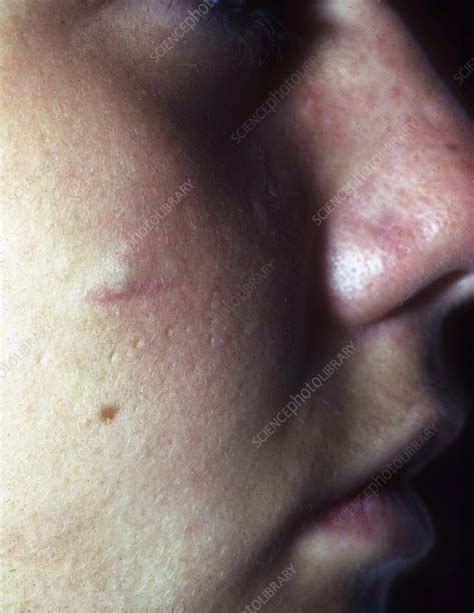 Sebaceous Cyst Stock Image C0577318 Science Photo Library