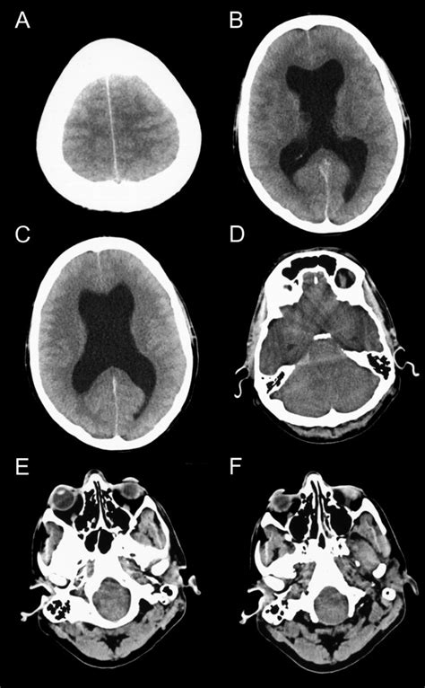Ct Brain Scan Signs Of Hydrocephalus High Intracranial Pressure And