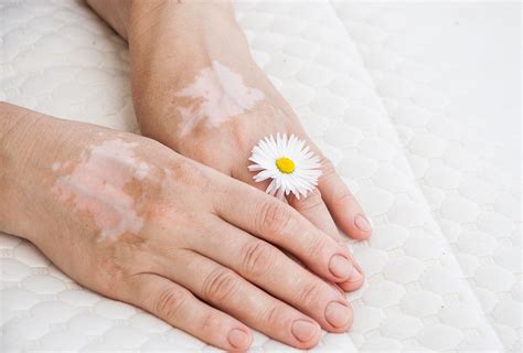 Vitiligo And White Patches On Skin Kicker