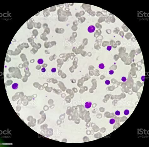 Microscopic View Of Cold Agglutinin Disease Autoimmune Hemolytic Anemia
