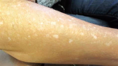 55 Year Old Male With Hypopigmented Macules On Forearms And Shins The