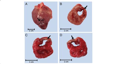 Images Of An Infarcted Fetal Heart At Post Mortem A Infarcted Fetal